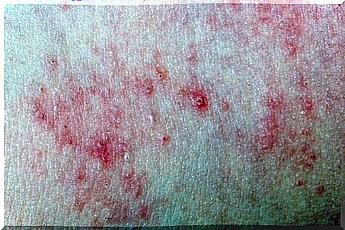 eczema on the skin