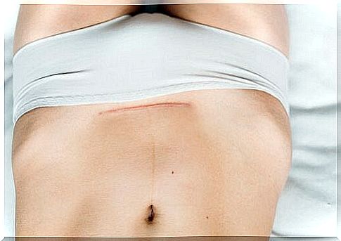 scars after caesarean section