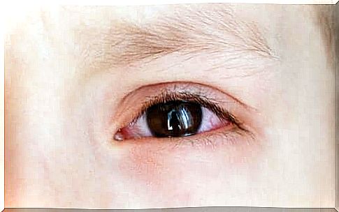 Causes of red eyes in children