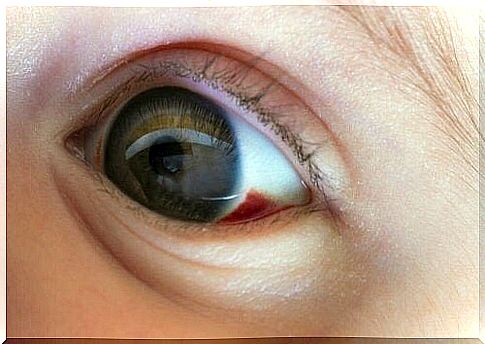 child with blood clot in the eye