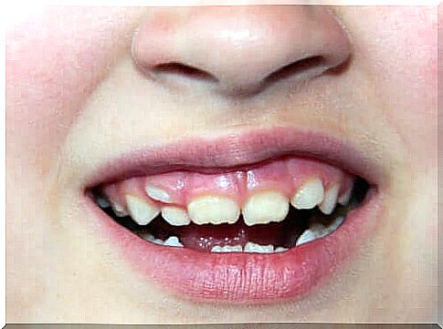 Skewed teeth in children: What should I do?