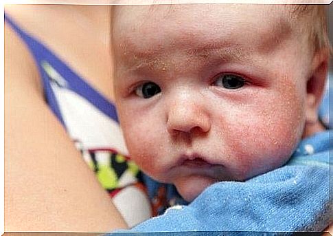 Baby with eczema 