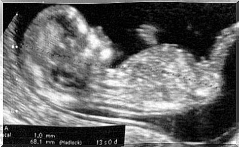 Ultrasound scan of baby