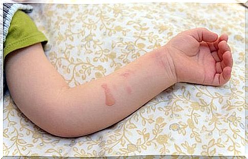 children with burns